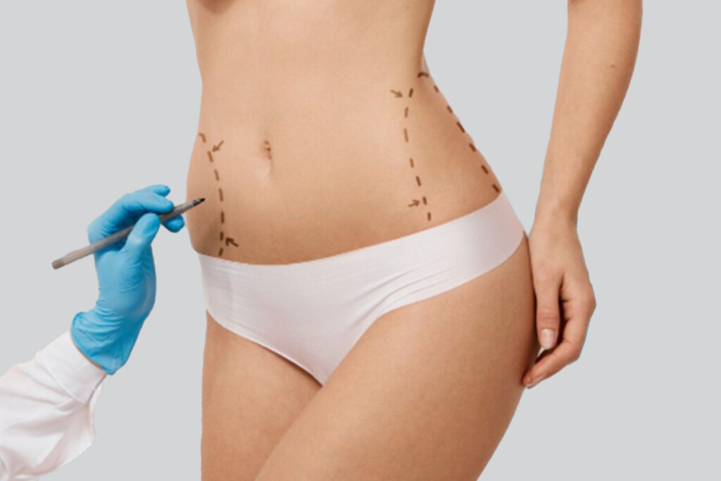 Abdominoplastia na Turquia