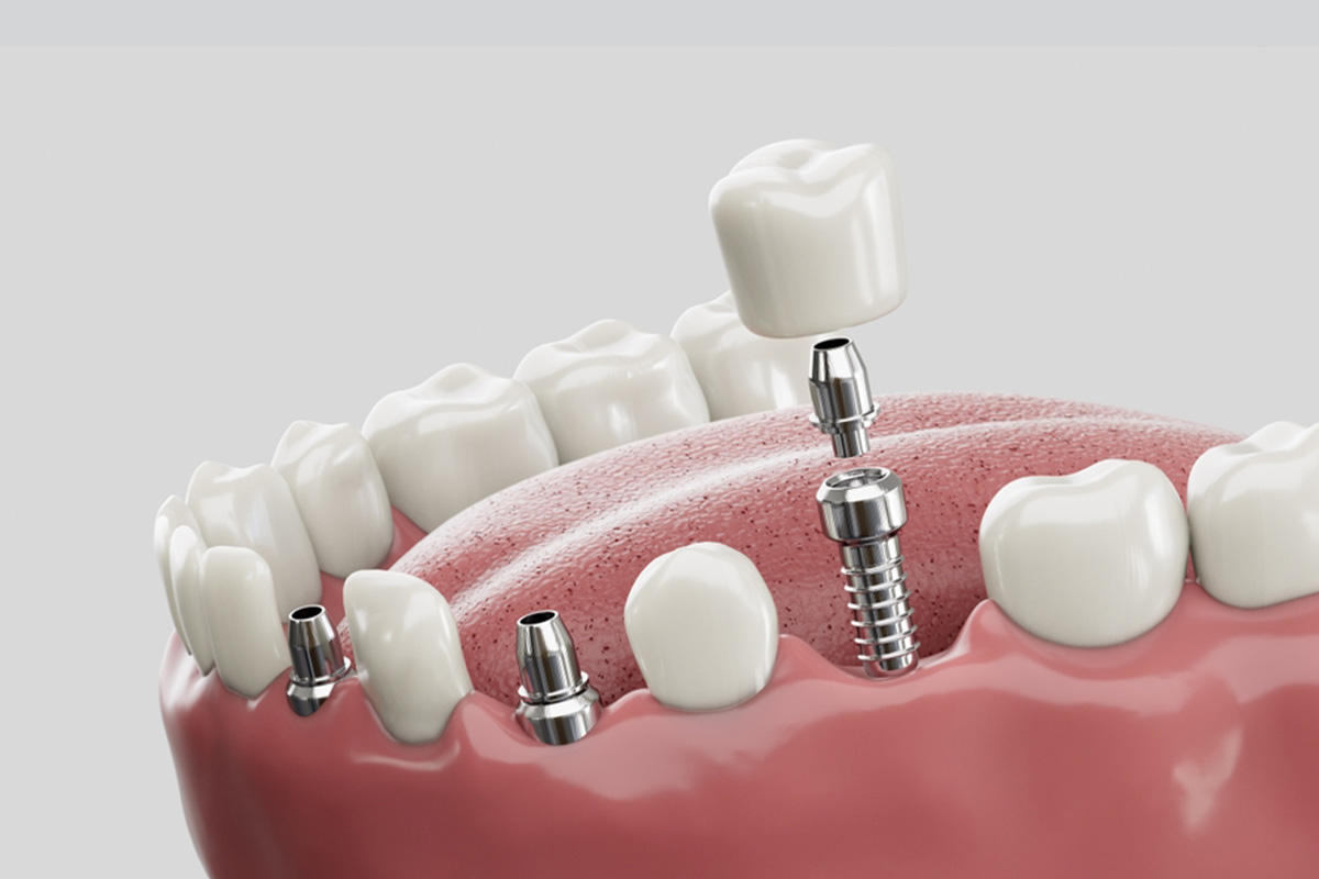 Implante Dentário na Turquia
